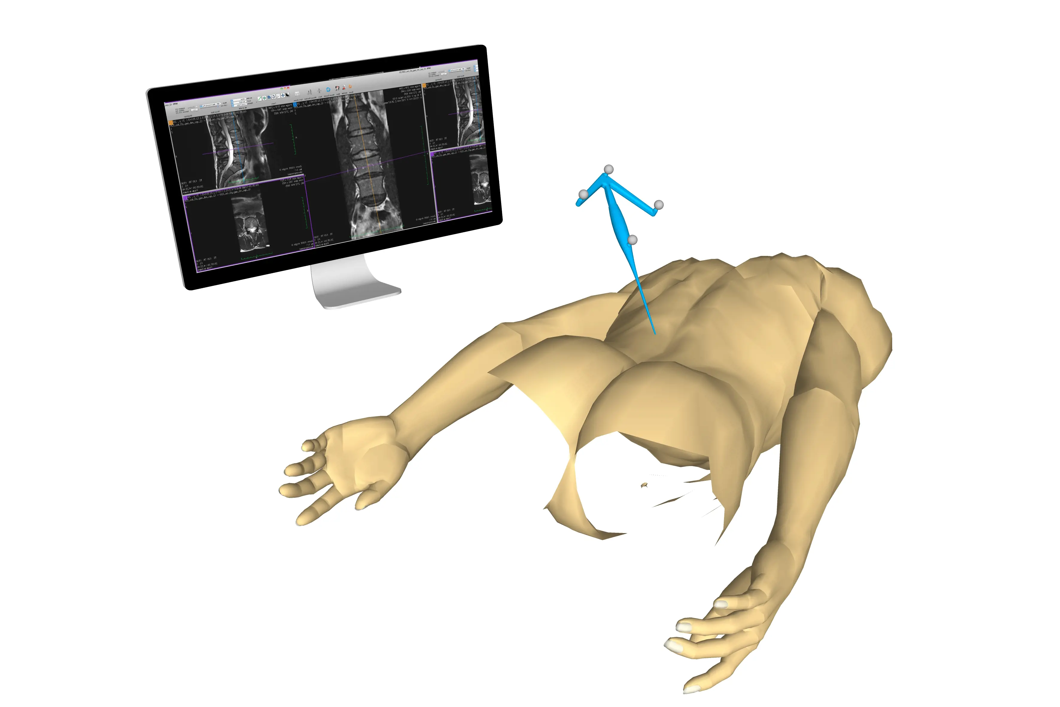 Illustrasjonsbilde av en rygg som viser hvordan kombinasjon av ultralydbilder og MR-bilder gjøres.