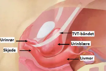 Illusrtasjo av hvordan urinrøret blir løftet ved hjelp av dette TVT-båndet.