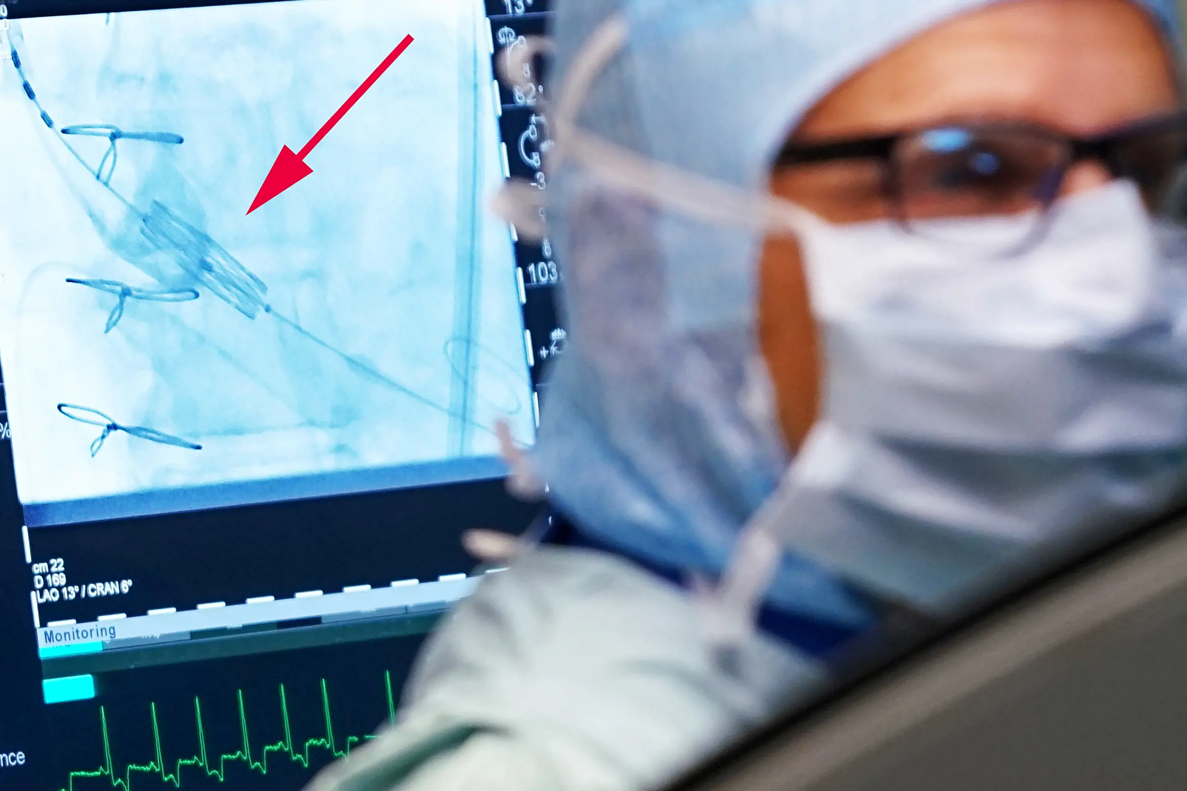 En PC skjem med et ultralydbilde som viser hvordan hjerteklaffen blir satt på plass inne i hjertet.